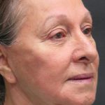 Rhinoplasty Before & After Patient #2891