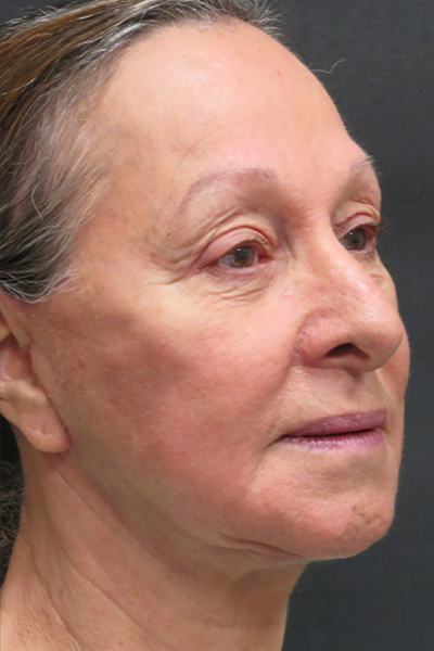 Rhinoplasty Before & After Patient #2891
