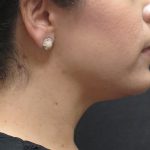 Chin Augmentation Before & After Patient #1561