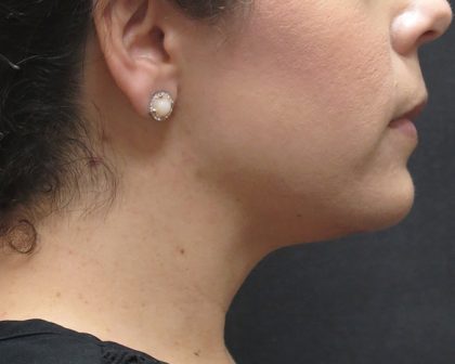 Chin Augmentation Before & After Patient #1561