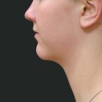 Fat Transfer Before & After Patient #1782