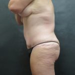 Mommy Makeover Before & After Patient #2542