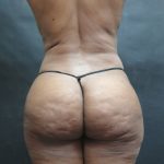 Mommy Makeover Before & After Patient #2618