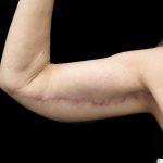 Arm Lift Before & After Patient #904