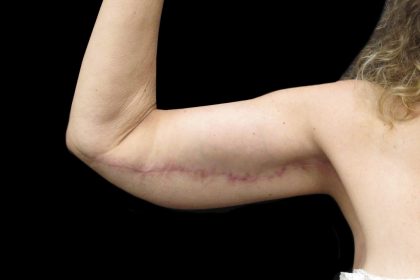Arm Lift Before & After Patient #904