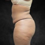 Mommy Makeover Before & After Patient #2587