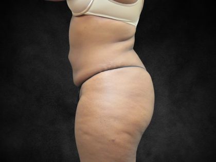 Mommy Makeover Before & After Patient #2587