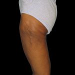 Thigh Lift Before & After Patient #3137