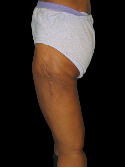 Thigh Lift Before & After Patient #3137
