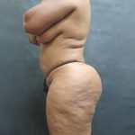 BBL / Brazilian Butt Lift / Gluteal Fat transfer Before & After Patient #1530