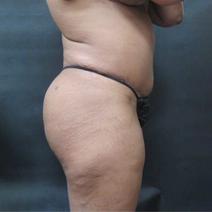 BBL / Brazilian Butt Lift / Gluteal Fat transfer Before & After Patient #1506