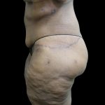 Post Weight Loss Before & After Patient #2749