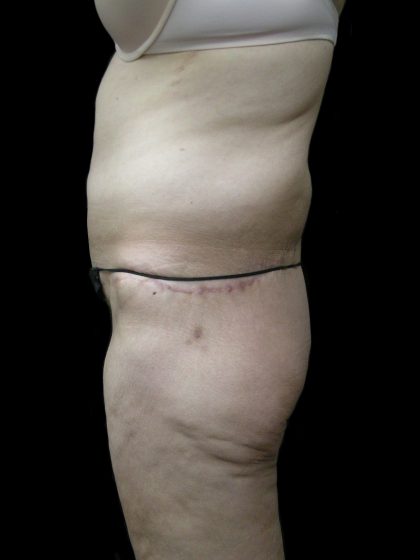 Post Weight Loss Before & After Patient #2770