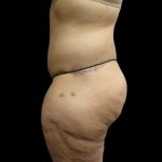 Post Weight Loss Before & After Patient #2791