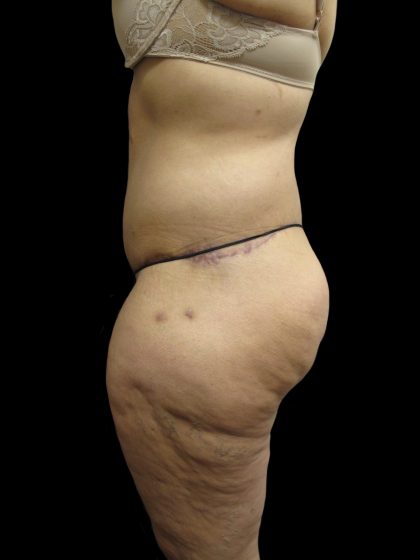 Post Weight Loss Before & After Patient #2791