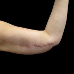 Arm Lift Before & After Patient #897
