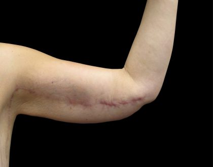 Arm Lift Before & After Patient #897