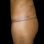 Lower Body Lift Before & After Patient #2327