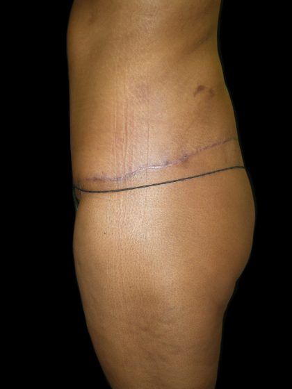 Lower Body Lift Before & After Patient #2327