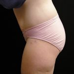 Lower Body Lift Before & After Patient #2285