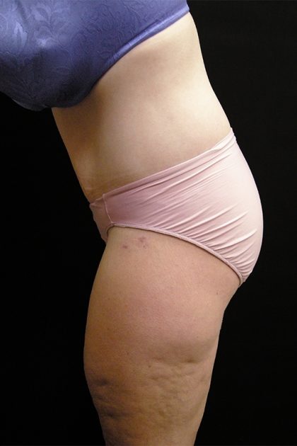 Lower Body Lift Before & After Patient #2285