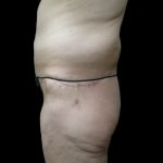Lower Body Lift Before & After Patient #2305