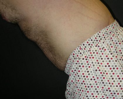 Lower Body Lift Before & After Patient #2269
