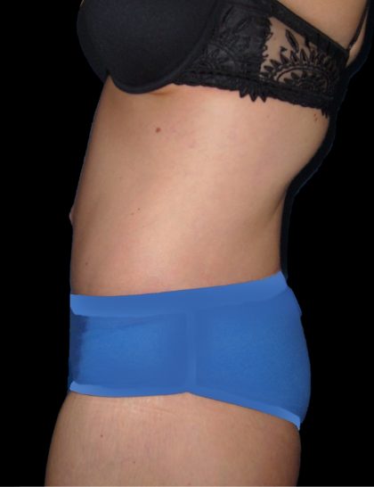 Lower Body Lift Before & After Patient #2278