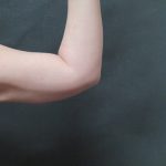 Liposuction Before & After Patient #936