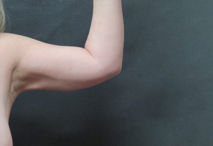 Liposuction Before & After Patient #936