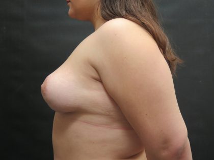 Breast Asymmetry Before & After Patient #943