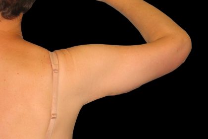 Arm Lift Before & After Patient #913