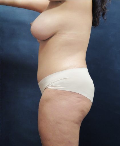 Mommy Makeover Before & After Patient #2635