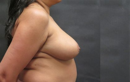 Breast Lift Before & After Patient #1279