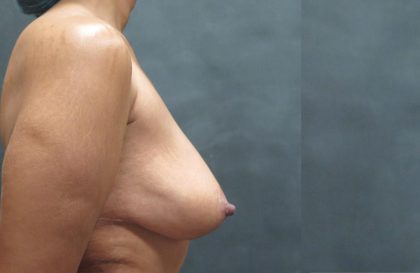 Breast Lift Before & After Patient #1244