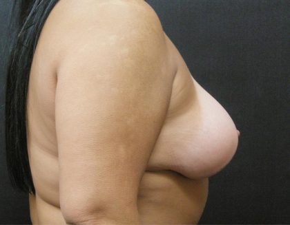 Breast Lift Before & After Patient #1237
