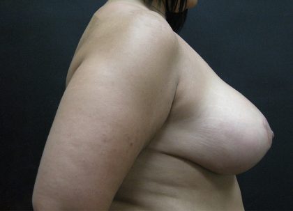 Breast Reduction Before & After Patient #1444