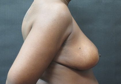 Breast Reduction Before & After Patient #1341