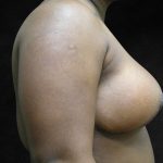 Breast Reduction Before & After Patient #1430