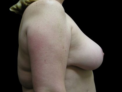 Breast Reduction Before & After Patient #1447