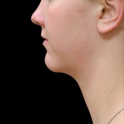 Scarless Facelift and Necklift Before & After Patient #3056