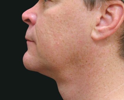 Scarless Facelift and Necklift Before & After Patient #3042