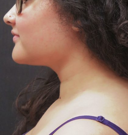 Scarless Facelift and Necklift Before & After Patient #3108