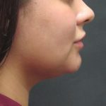 Scarless Facelift and Necklift Before & After Patient #3028