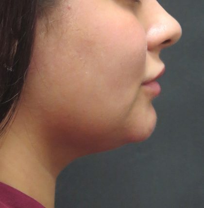 Scarless Facelift and Necklift Before & After Patient #3028