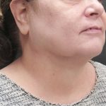 Scarless Facelift and Necklift Before & After Patient #3049