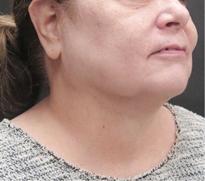 Scarless Facelift and Necklift Before & After Patient #3049