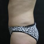 Mommy Makeover Before & After Patient #2657