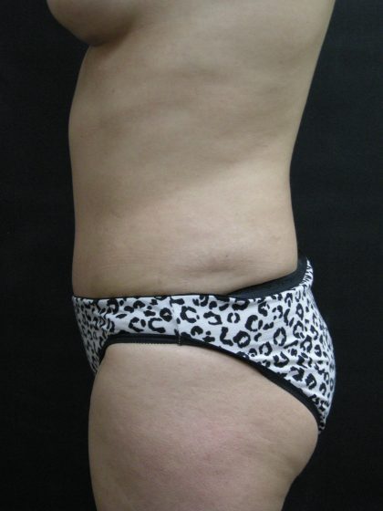 Mommy Makeover Before & After Patient #2657