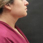 Scarless Facelift and Necklift Before & After Patient #3067